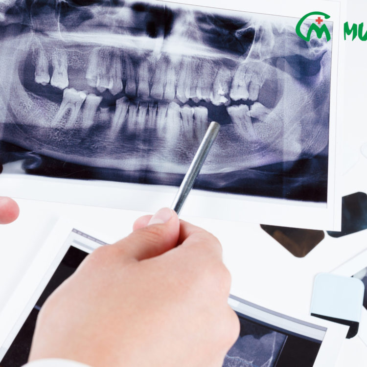 Pantomogram zdjęcia rtg zębów Lublin